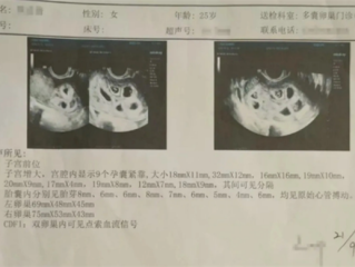 怀9胞胎女子丈夫决定减胎：可能需要多次手术！